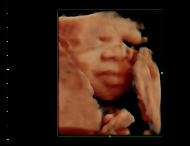 3D ultrasound image at 28 weeks